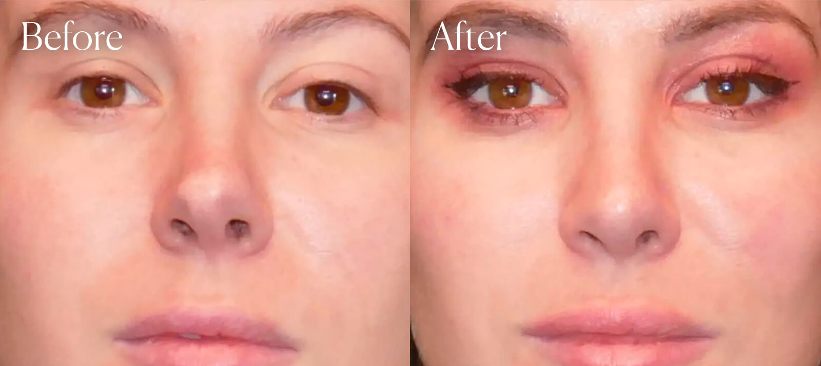revision-before-and-after-rhinoplasty revision before and after rhinoplasty