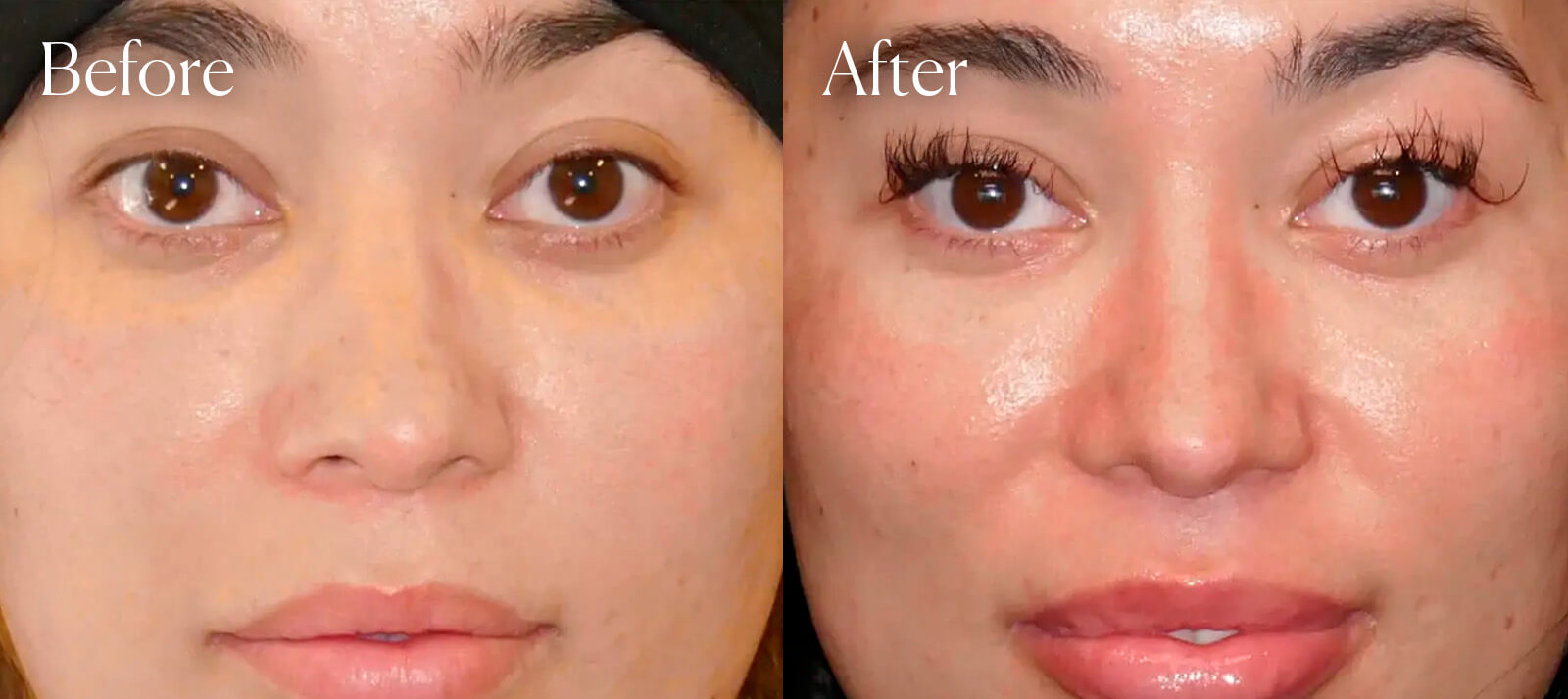 revision-ethnic-plastic-surgery-rhinoplasty revision ethnic plastic surgery rhinoplasty