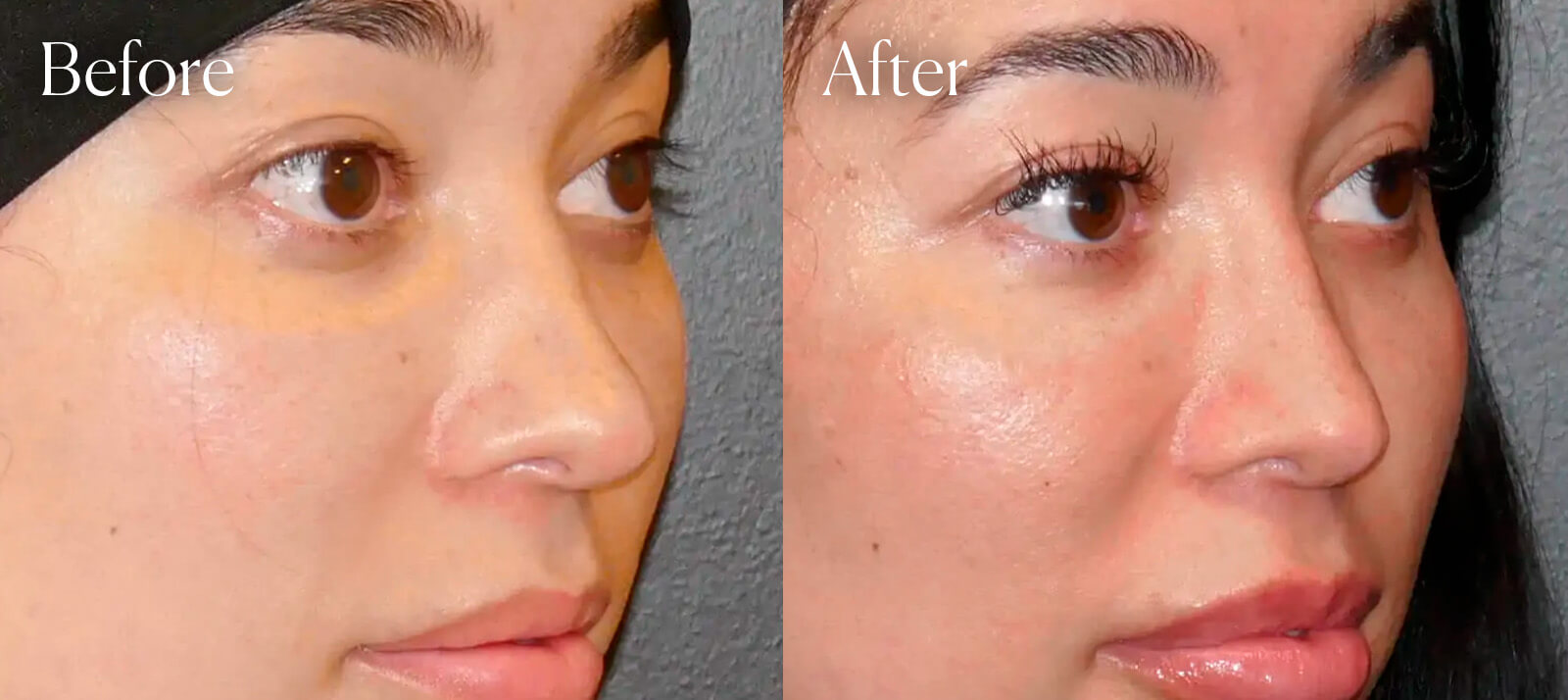 revision-plastic-surgery-ethnic-rhinoplasty revision plastic surgery ethnic rhinoplasty