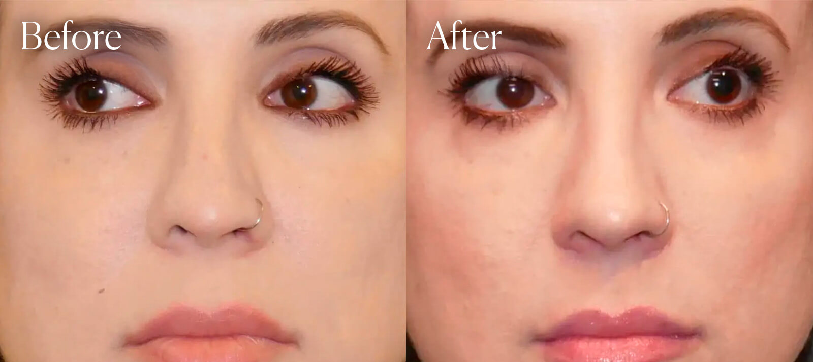 revision-plastic-surgery-rhinoplasty revision plastic surgery rhinoplasty