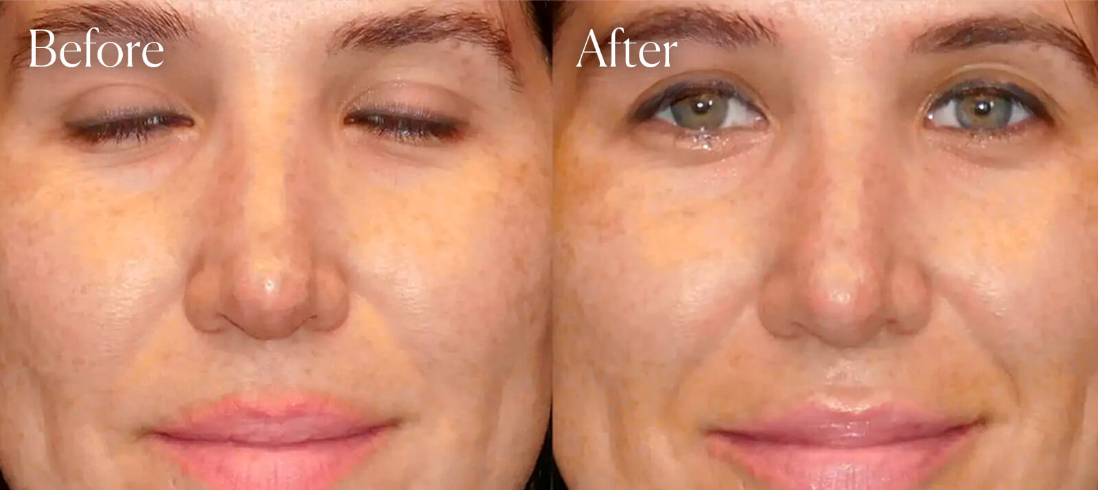 revision-tip-procedure-colorado-rhinoplasty revision tip procedure colorado rhinoplasty