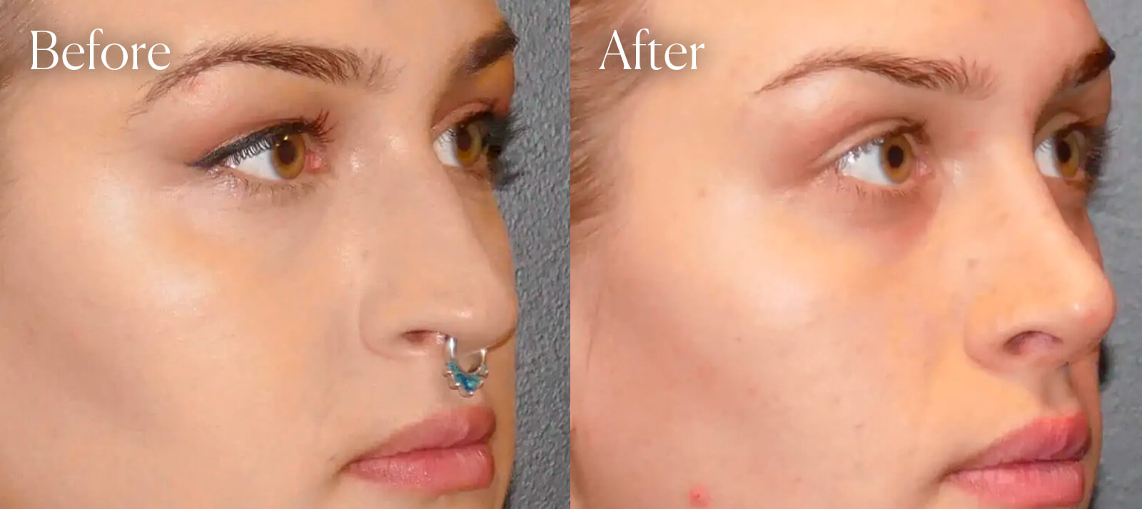 surgery-aesthetic-rhinoplasty surgery aesthetic rhinoplasty