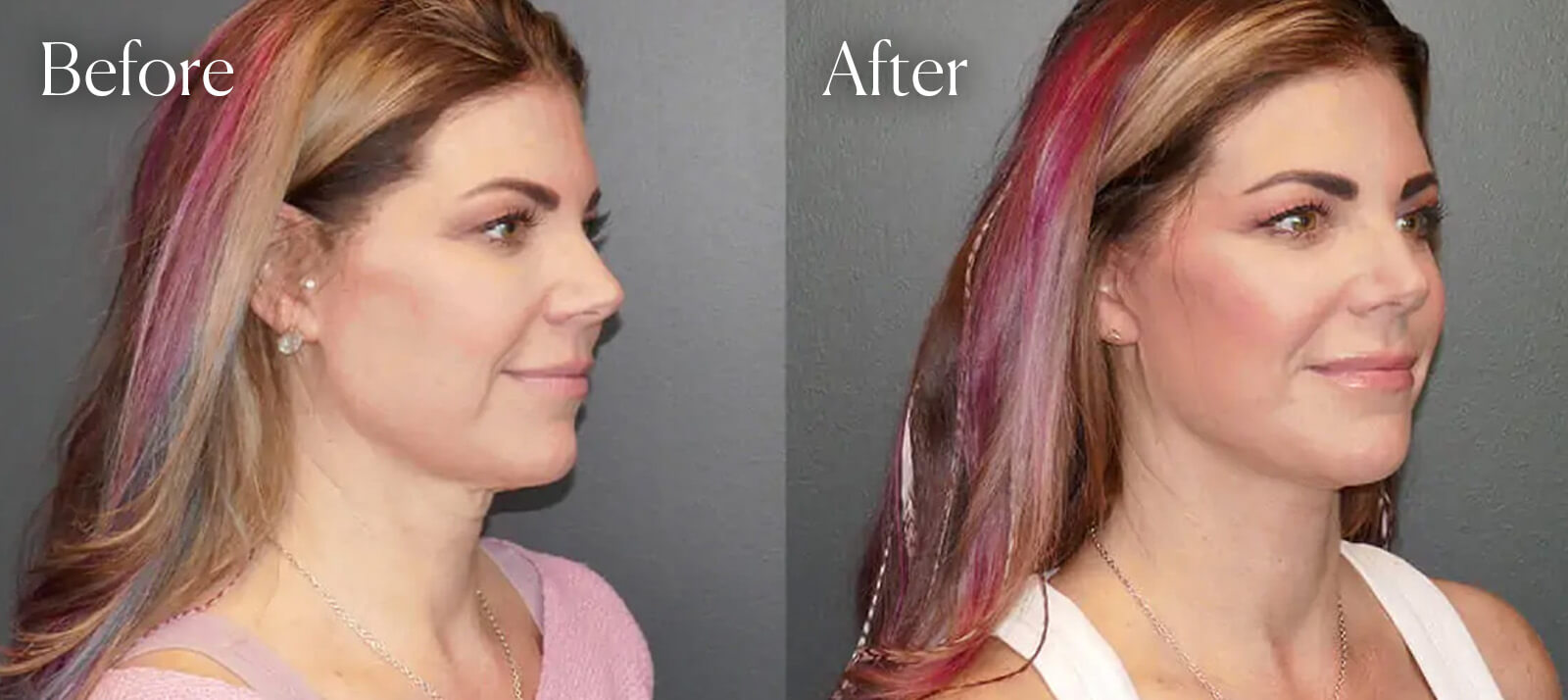 surgery-deep-plane-facelift-results surgery deep plane facelift results