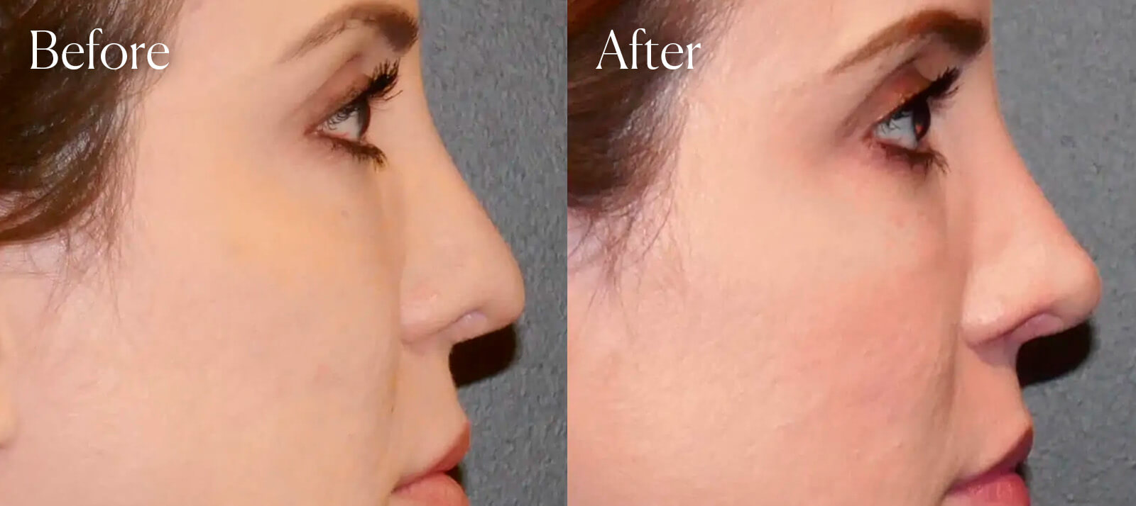 surgery-plastic-revision-rhinoplasty surgery plastic revision rhinoplasty