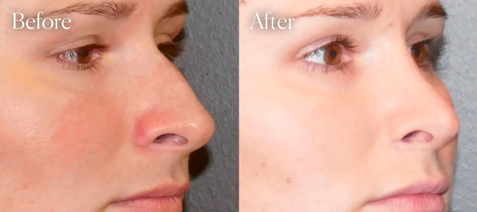 surgery-plastic-rhinoplasty surgery plastic rhinoplasty