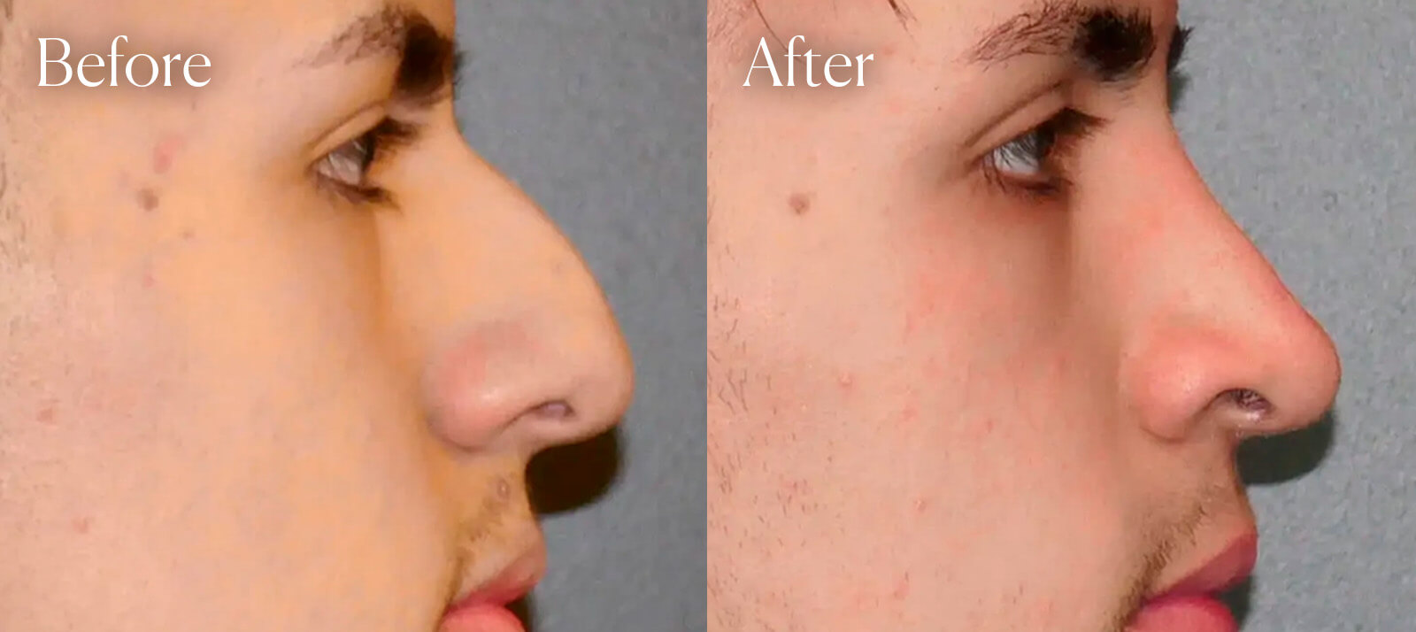 surgery-results-ethnic-ultrasonic-rhinoplasty surgery results ethnic ultrasonic rhinoplasty