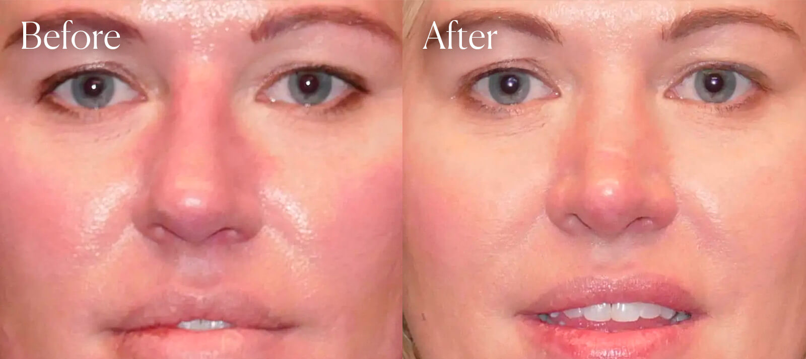 surgery-results-rhinoplasty surgery results rhinoplasty