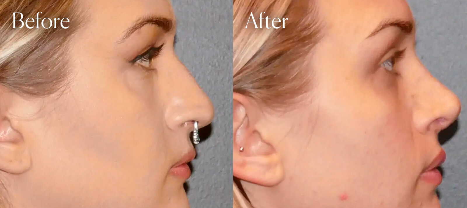 surgery-rhinoplasty-aesthetic surgery rhinoplasty aesthetic
