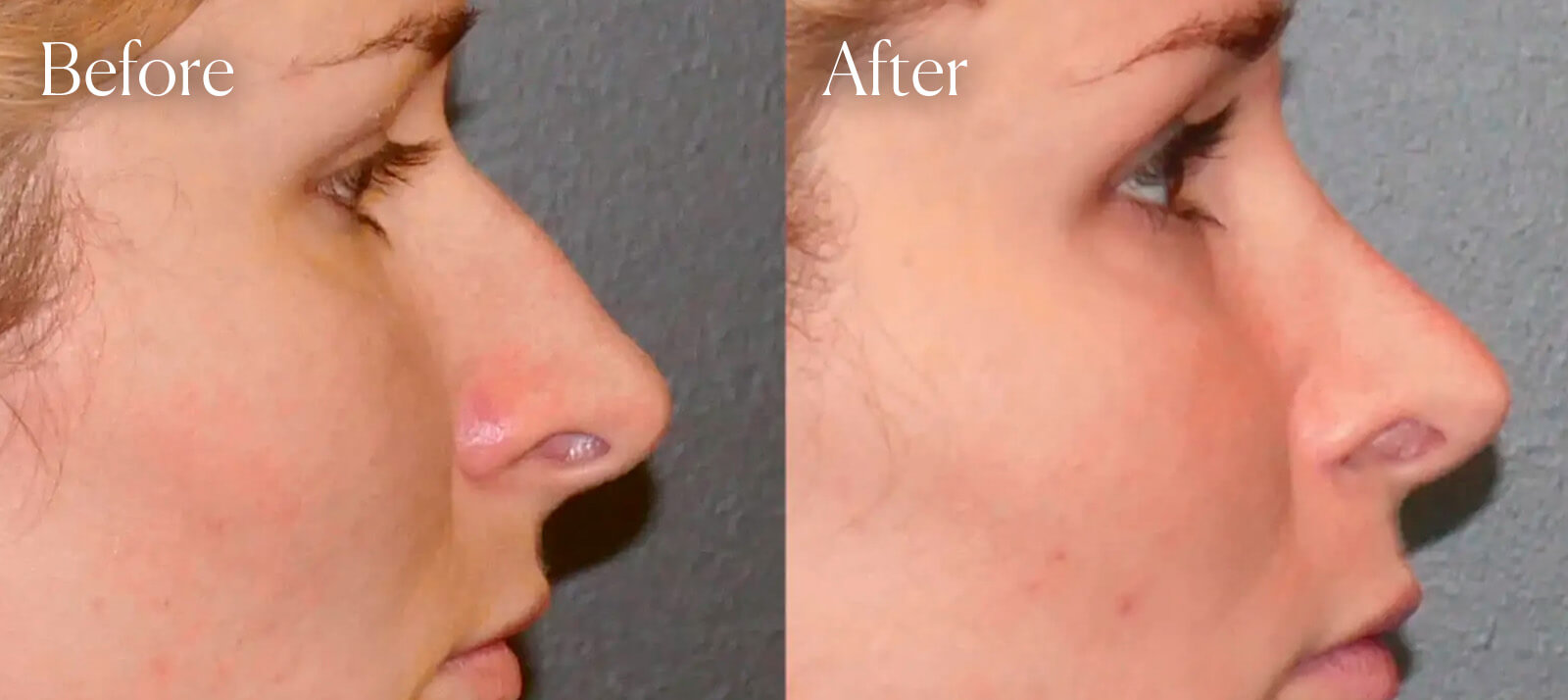 surgery-rhinoplasty-plastic surgery rhinoplasty plastic