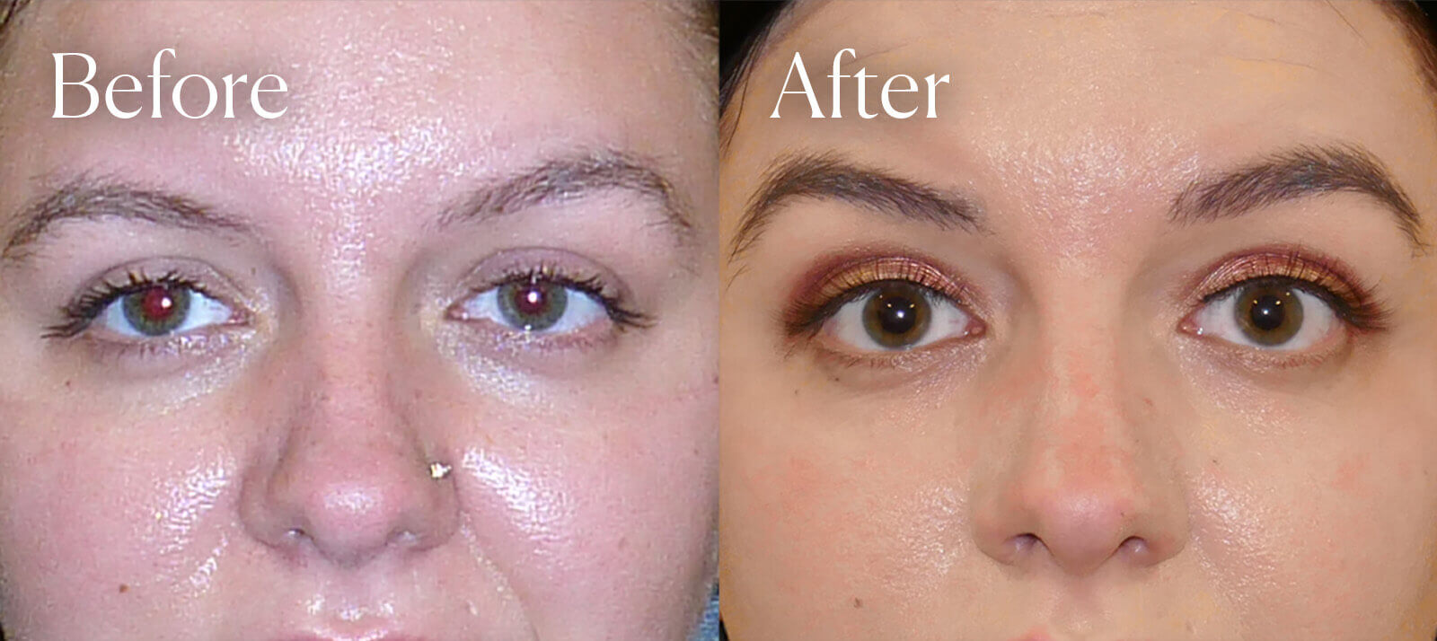 temporal browlift facial procedure