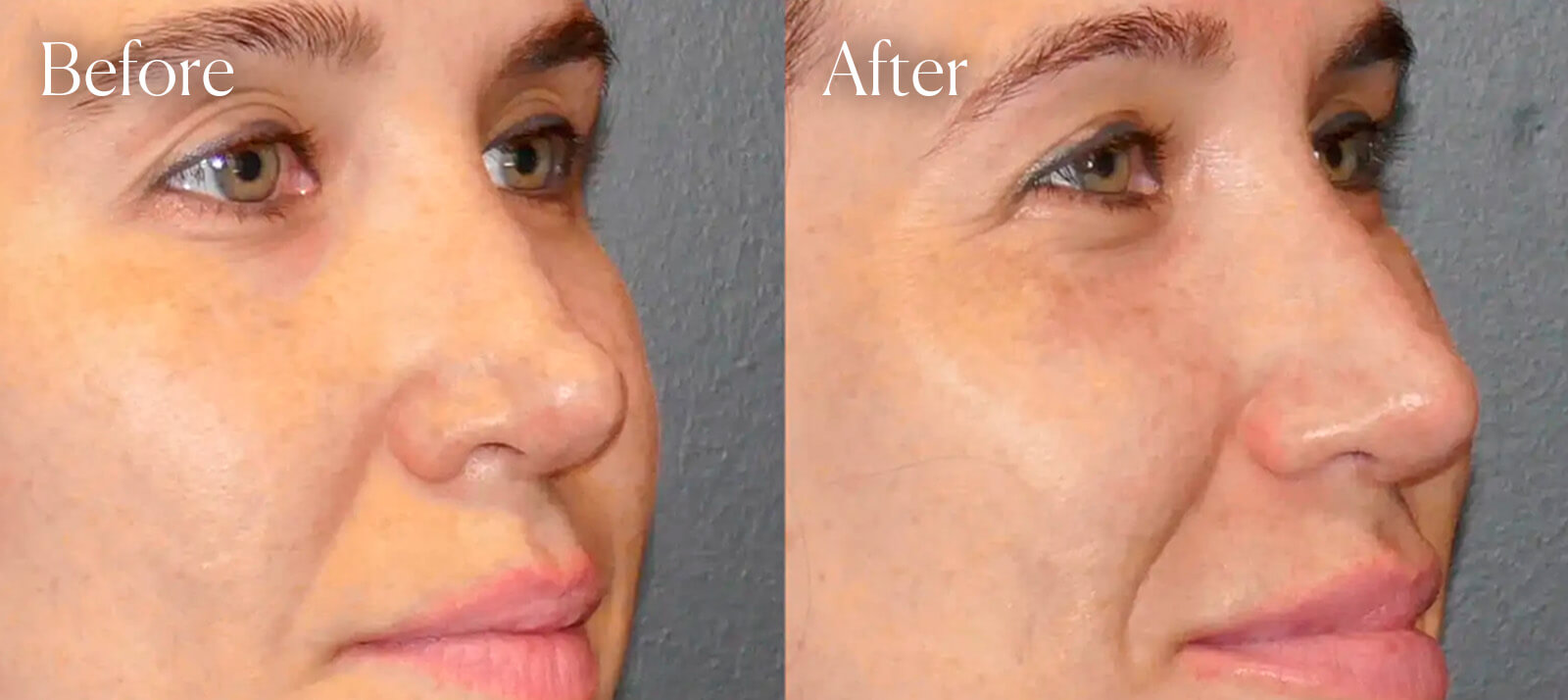 tip-procedure-colorado-revision-rhinoplasty tip procedure colorado revision rhinoplasty