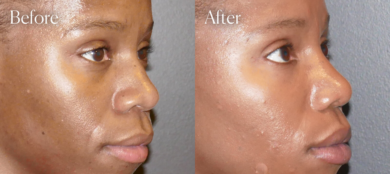 ultrasonic-aesthetic-surgery-ethnic-rhinoplasty ultrasonic aesthetic surgery ethnic rhinoplasty