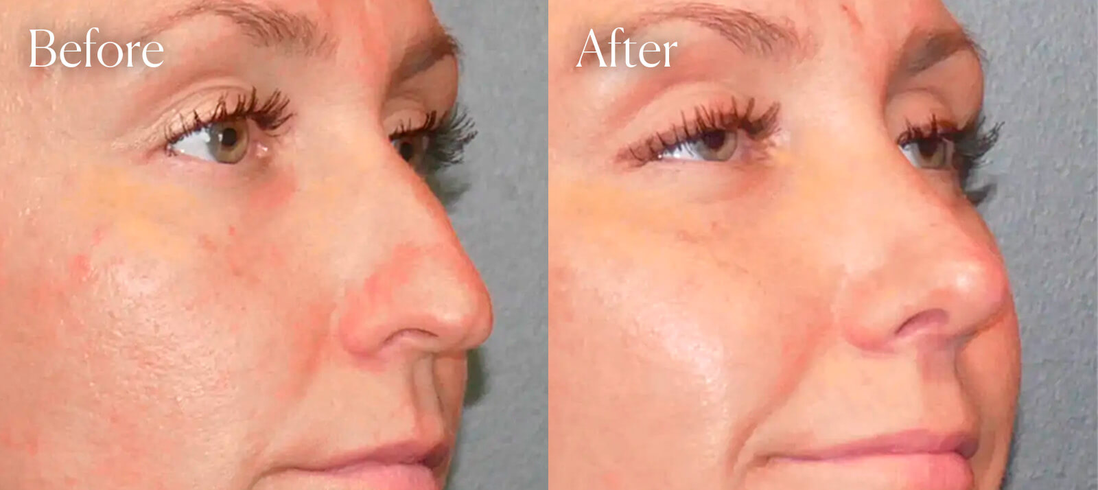ultrasonic-aesthetic-surgery-preservation-rhinoplasty ultrasonic aesthetic surgery preservation rhinoplasty