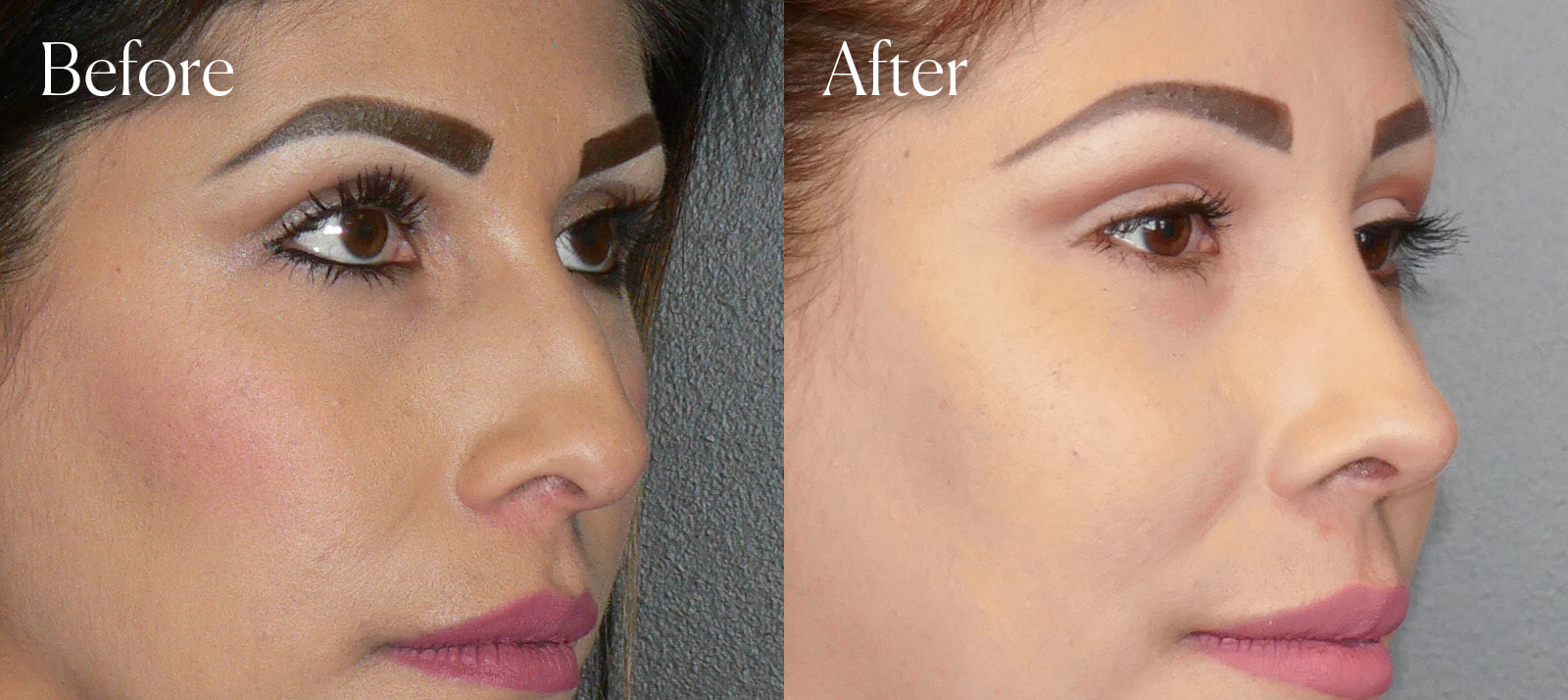 ultrasonic-before-and-after-ethnic-rhinoplasty ultrasonic before and after ethnic rhinoplasty